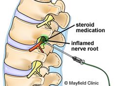 Nerve Root Injection